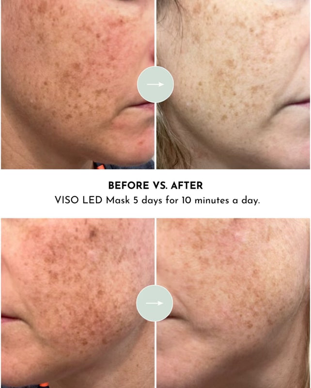VISO – Anti-Aging Red Light Mask for At-Home Skin Rejuvenation